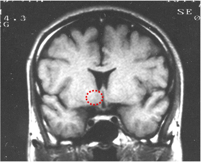図２：筆者の脳のMRI像（30年前）　　　赤い破線で囲まれた領域に発熱中枢がある。